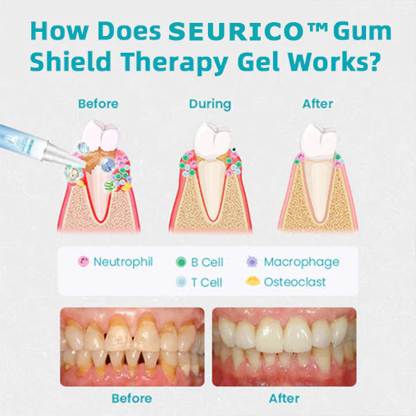 🔥Last Day 69% OFF-SEURICO™ Gum Shield Therapy Gel