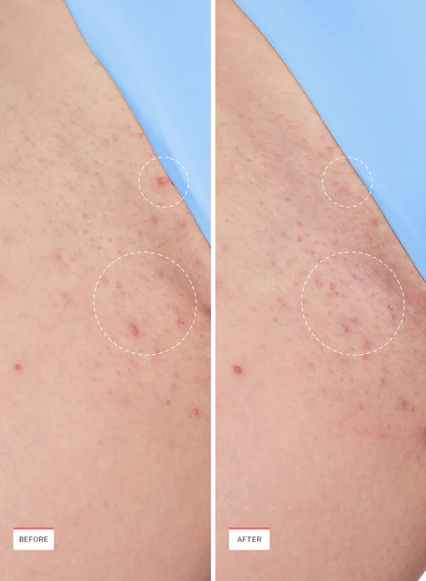 Final 3 Hours: 70% OFF 🔥Smoothing Solution Ingrown Hair Treatment — 🌟Complete Shave + Care Routine🌟